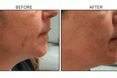 LB Lasers Vbeam - Patient9