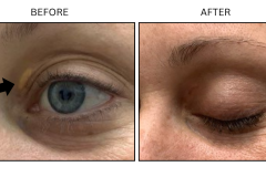 LB Surgical Xanthelasma - Patient1