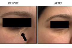 LB Surgical Xanthelasma - Patient2