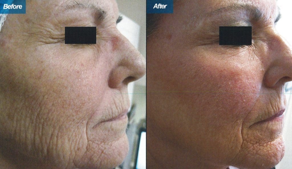 CO2 Resurfacing Laser: Before, During, After
