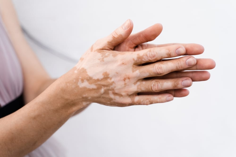 Melasma Treatment Los Angeles CA