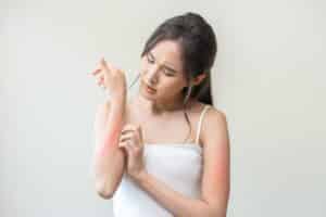 Woman itching her arm due to eczema flare up in Los Angeles, CA