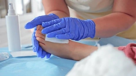 Person's foot after wound care from skin cancer in Los Angeles, CA