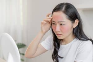 Woman looking at her red skin in the mirror due to rosacea in Los Angeles, CA