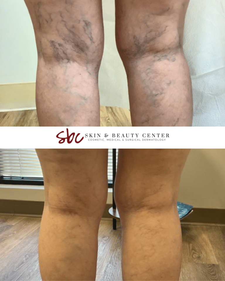 beforeaftersclerotherapy