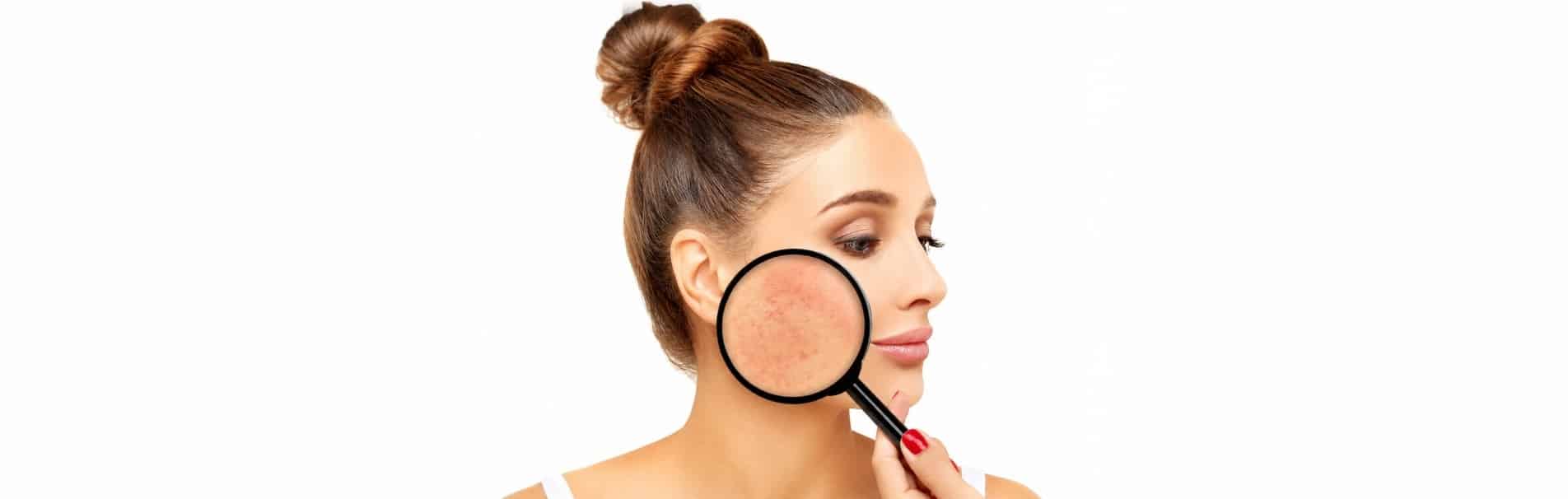 Woman with rosacea