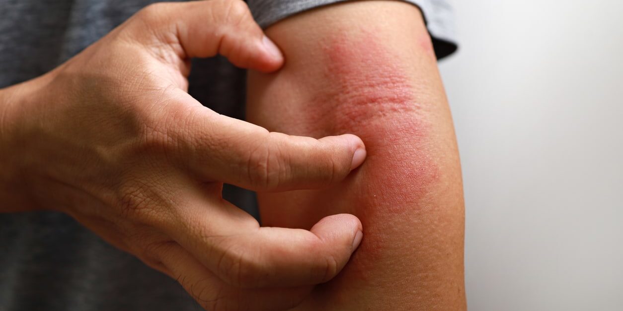 Eczema (Atopic Dermatitis)