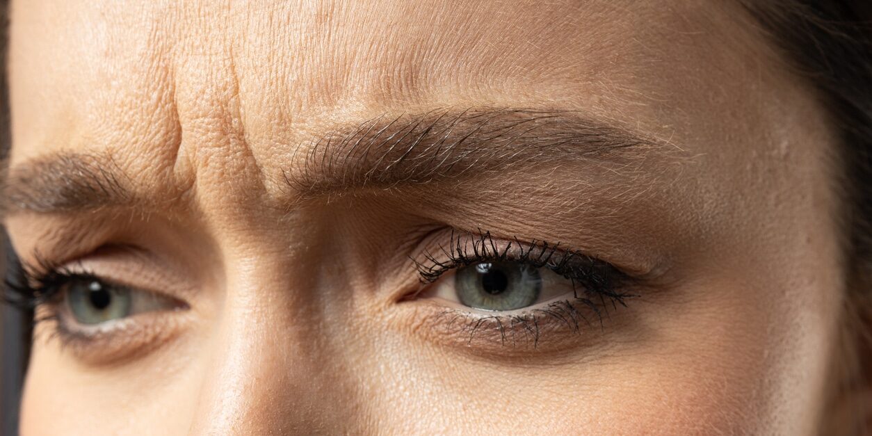 Glabellar Lines (wrinkles between the eyebrow)